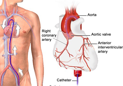 Coronary Angiography11