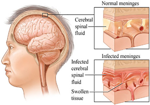 بیماری مننژیت کنسرسیوم ایرکاس