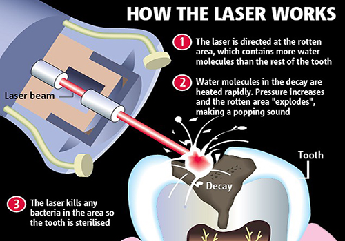 laser dentistry1