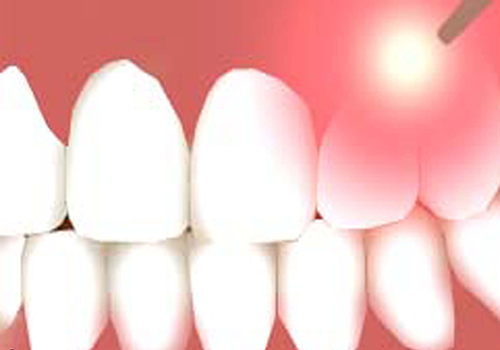 کاربرد های لیزر در دندانپزشکی 1