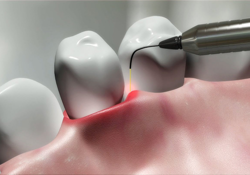 کاربرد های لیزر در دندانپزشکی 3