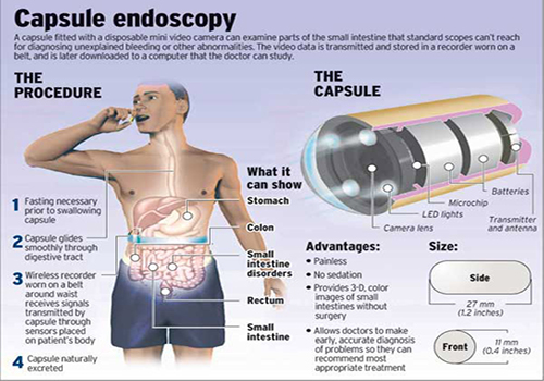 Capsule Endoscopy